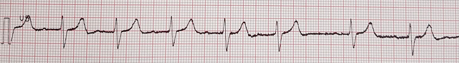 Electrocardiogram